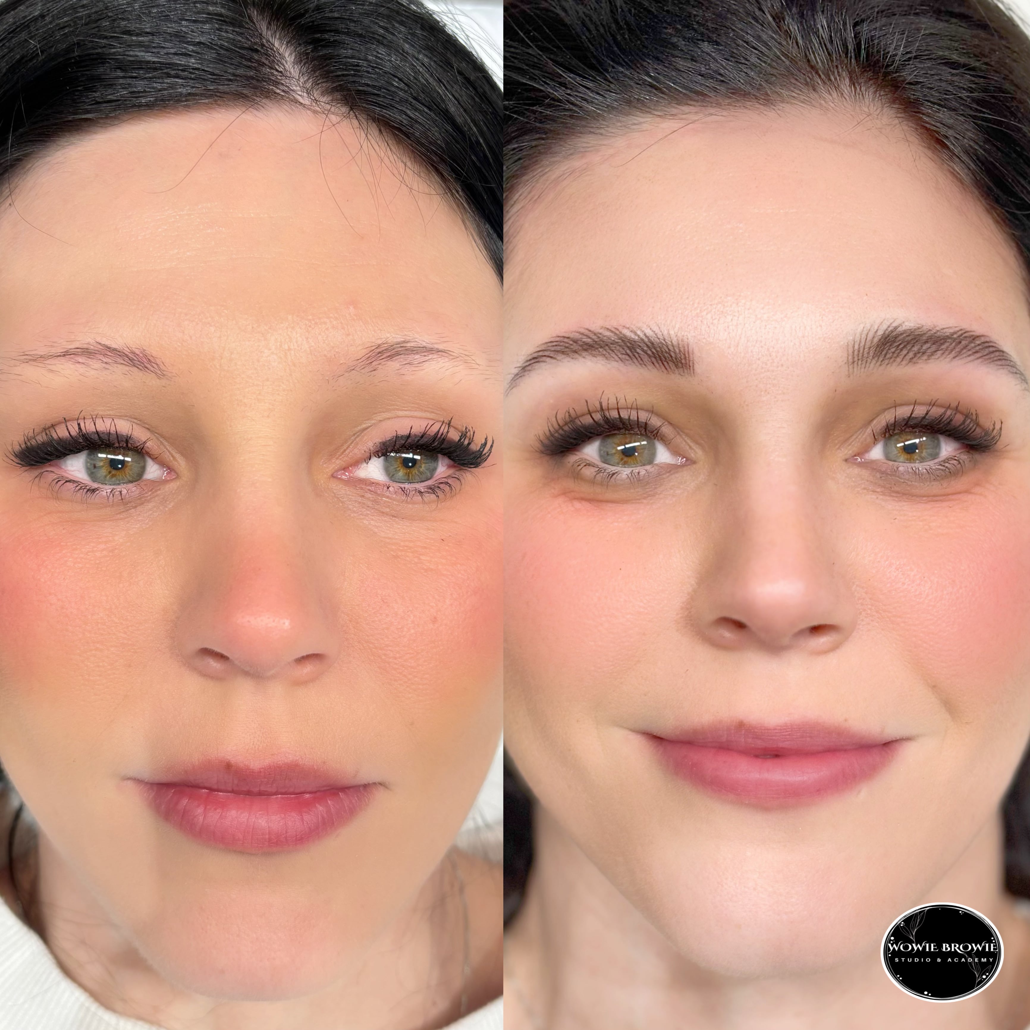 Plasma Eyebrow Removal