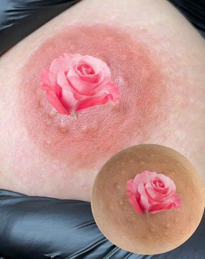 Areola Pigmentation